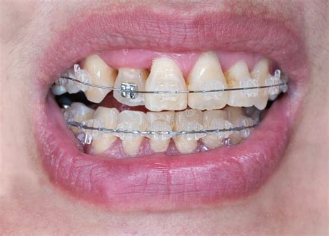 Crooked teeth with braces stock image. Image of closeup - 77744681