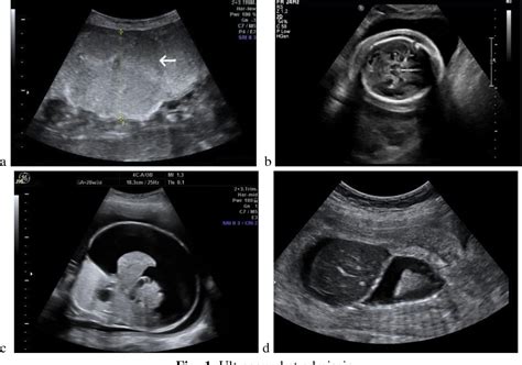 Hydrops Ultrasound