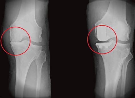 Partial Knee Replacement and Second Opinions: Apurva Dalal, MD, FAAOS ...