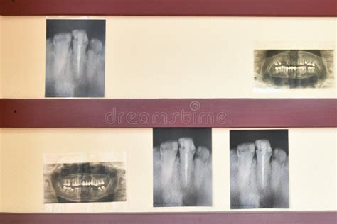 X-ray of Teeth. Problem Teeth. a Problem with the Teeth Stock Image ...