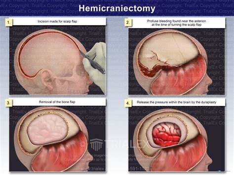 Hemicraniectomy - TrialQuest Inc.