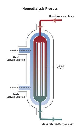 Hemodialysis - Capital Nephrology Medical Group