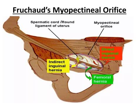 Myopectineal Orifice