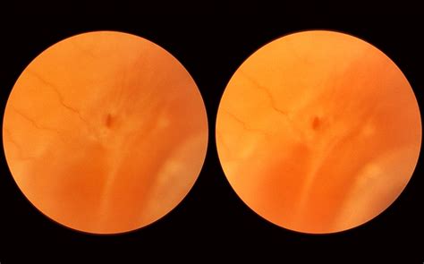 Pars Planitis - Peripheral Uveitis - Retina Image Bank