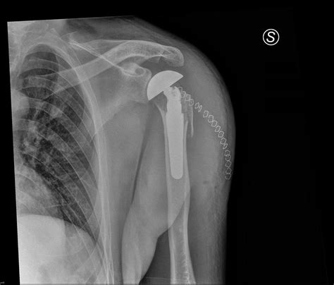 Shoulder Hemiarthroplasty Treatment | Dr Kaushik Reddy