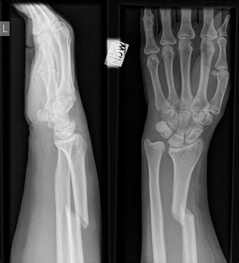 Anteroposterior and lateral radiographs demonstrating Galeazzi ...