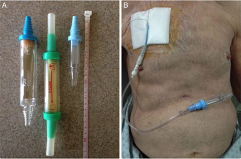 Heimlich Chest Drain Valve - Best Drain Photos Primagem.Org