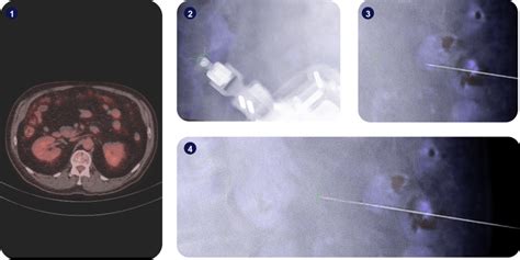 Micromate™ Case Report: Robotic-Assisted Omental Biopsy