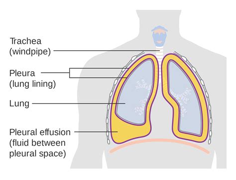 Plan de cuidados de enfermería y gestión del derrame pleural 【2024】