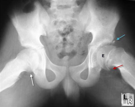 LearningRadiology - Slipped Capital Femoral Epiphysis, SCFE