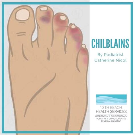 Chilblains | Risks, Prevention and Treatment of Chilblains