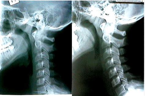 Cervical Lordosis correction using Atlas Orthogonal technique