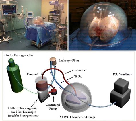 Ex vivo lung perfusion (EVLP) | SpringerLink