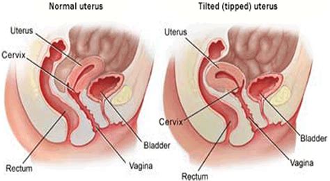 Tilted Uterus - Causes, Symptoms, Diagnosis, Treatment and Pregnancy