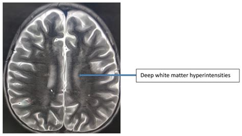 MRI of the brain: multiple enhancing confluent white matter lesions of... | Download Scientific ...