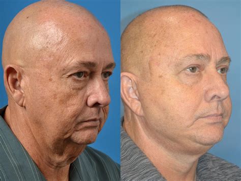 Male Facelift Photos | Melbourne, FL | Patient 56595