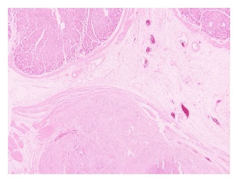 Poorly differentiated adenocarcinoma on gastroesophageal junction (a ...