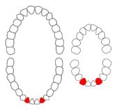 Mandibular lateral incisor - Wikipedia, the free encyclopedia