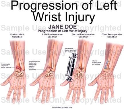 Wrist Ligament Injury | Wrist injury, Ligament injury, Injury