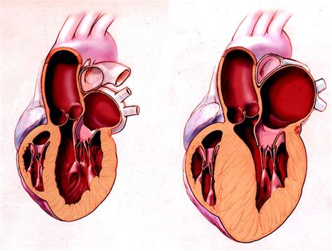 What is Hypertrophic Cardiomyopathy? - Cardiology Specialist Houston ...