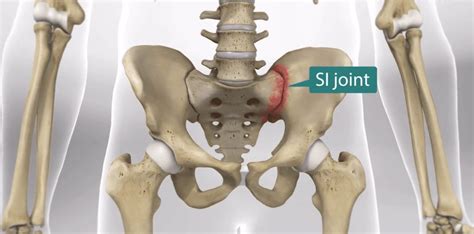 SI Joint Pain Symptoms & Treatment Options | Florida Surgery Consultants