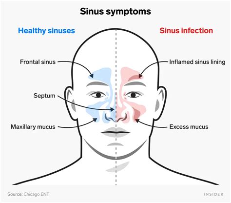 SINUS PRESSURE – Rohini ENT Clinic