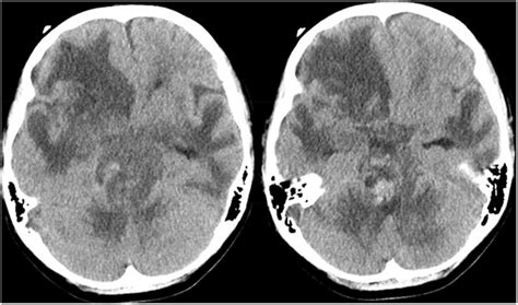 CT scan of the brain showing interval expansion of the intraparenchymal... | Download Scientific ...