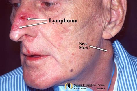 Cutaneous Lymphoma: Please Contribute To The Leukemia & Lymphoma ...