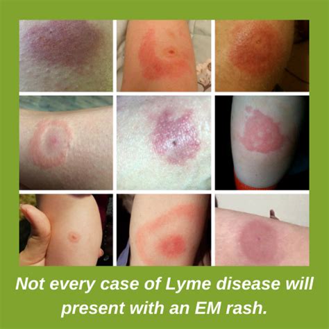 Lyme Disease UK - a brief explanation of Lyme disease in the UK