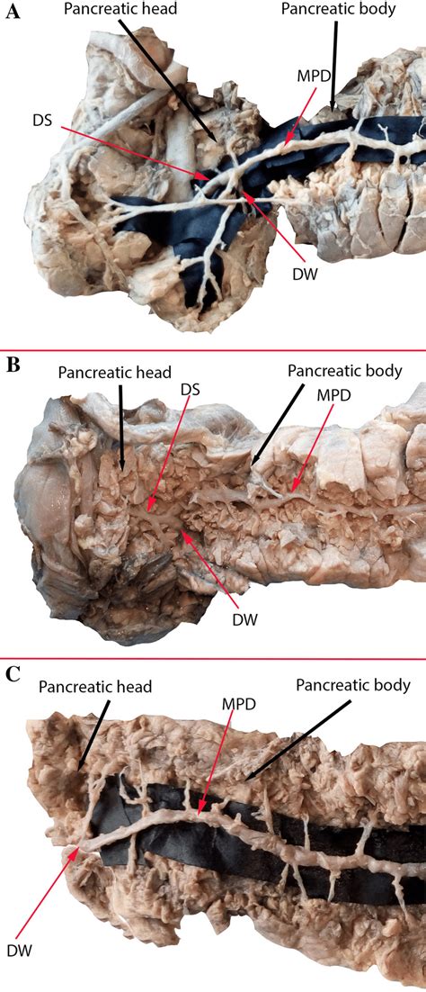 Dominant drainage by one of the ducts. A—type I, B—type II, C—type III ...