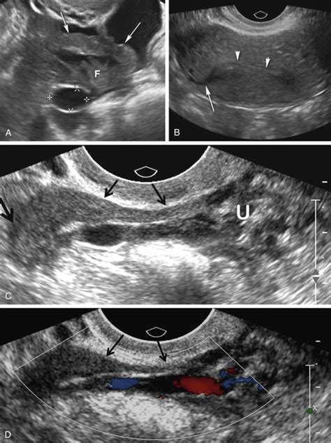 Ultrasound Evaluation of the Fallopian Tube | Obgyn Key