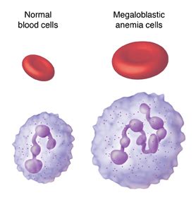 When Your Child Has Megaloblastic Anemia | Saint Luke's Health System