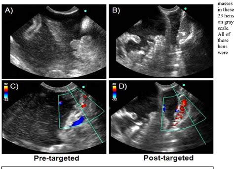 Stage 4 Ovarian Cancer Ultrasound - CancerWalls