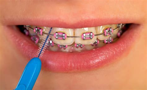 3 Dental Care Tips to Keep Your Teeth Clean When You Have Braces - Nicholas J. Hurley D.D.S., P ...