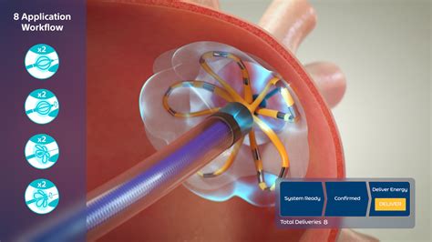 Medical Device Animation: Farapulse Pulsed Field Ablation (PFA) System ...