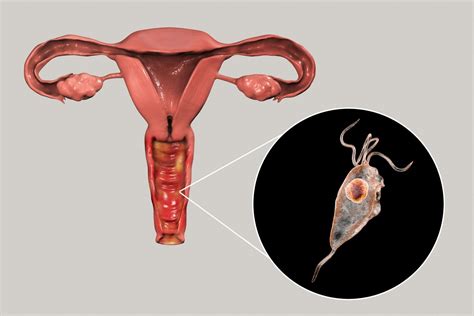 Trichomonas Vaginitis Discharge