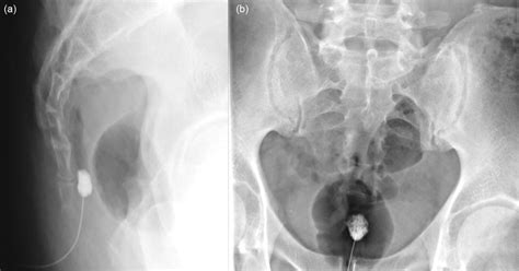 Complications of Ganglion Impar Block | Anesthesia Key