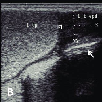 Ultrasound image of pampiniform plexus. (A) Right pampiniform plexus... | Download Scientific ...