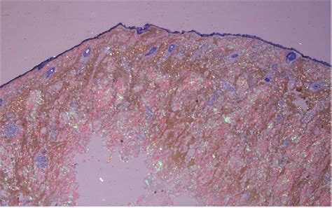 Case 2 -Congo Red Stain. Polarized microscopy reveals the... | Download Scientific Diagram