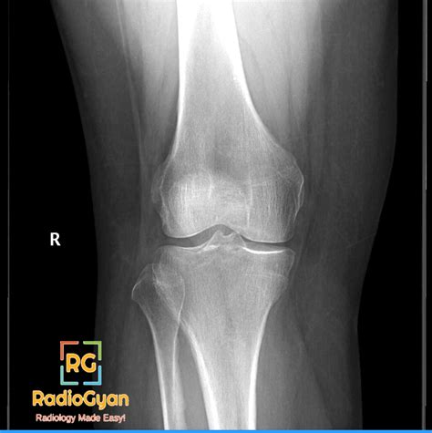 Schatzker Classification of Tibial Plateau Fractures - RadioGyan