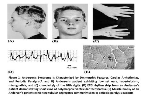 channelopathies