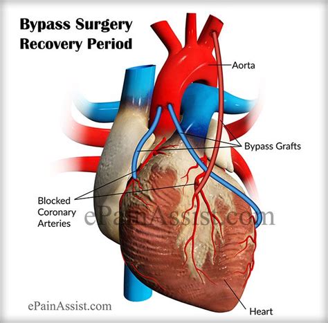 Bypass surgery recovery period depends on individual’s prior health condition and age and ...