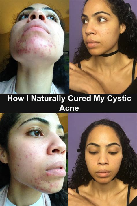 How I Naturally Cured My Hormonal Cystic Acne. Remove dairy , heal the ...