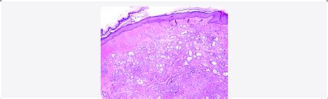 Ceruminous adenoma depicting glandular configurations lined by two... | Download Scientific Diagram