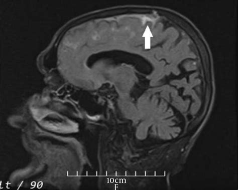 Brain MRI (FLAIR sequence) parasagittal plane image shows... | Download Scientific Diagram