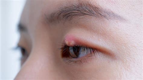 How Warm Compress Can Help Treat an Eye Stye | Dr. D'Orio Eyecare