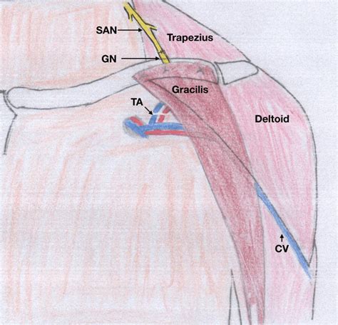 Schematics for gracilis free transfer using the spinal accessory nerve... | Download Scientific ...