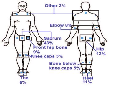 Common pressure points in the human body with the frequency of PU... | Download Scientific Diagram