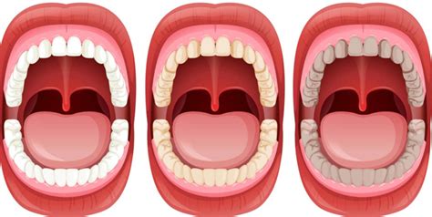 Uvula Swelling: Symptoms, Causes, Treatment Of This Condition ...