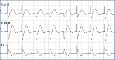 Transcutaneous Pacing (TCP) With and Without Capture - ACLS Medical ...